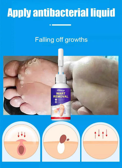 【Apply and peel】Corn remover